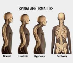 Lordosis Is A Common Treatable ...